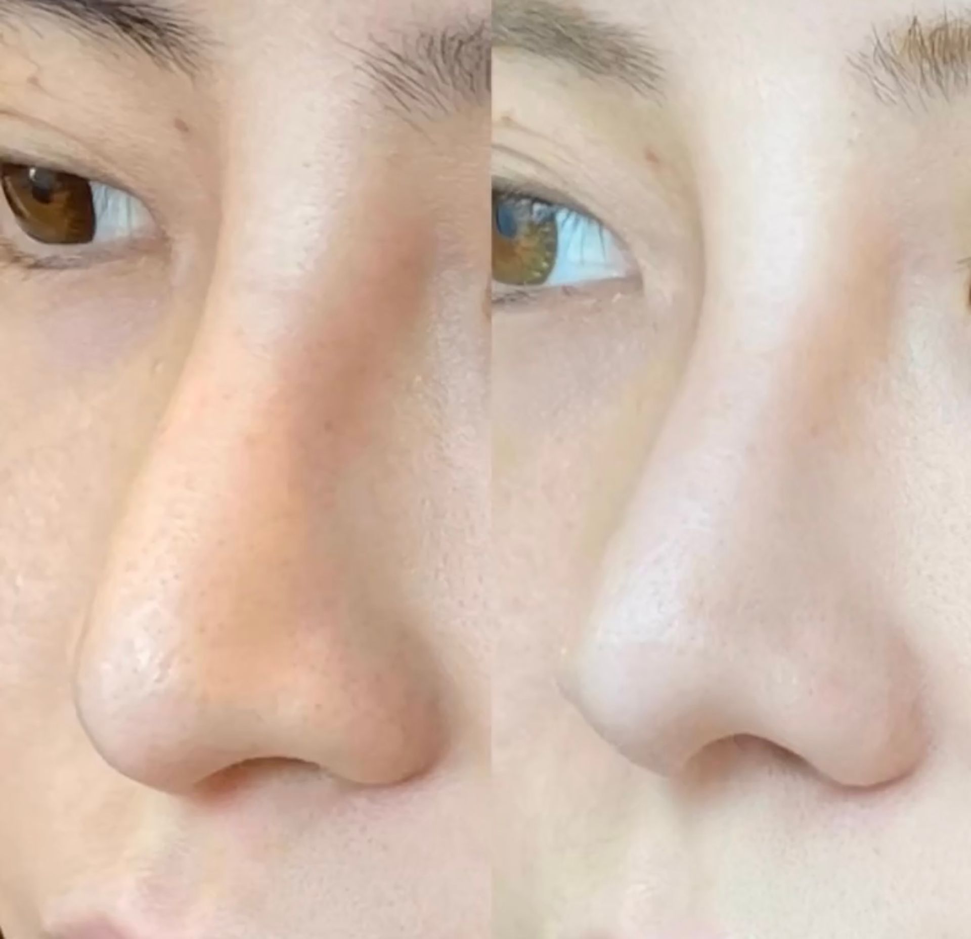 Comparison of two close-up nose profiles. The left shows a larger, shadowed nose. 
