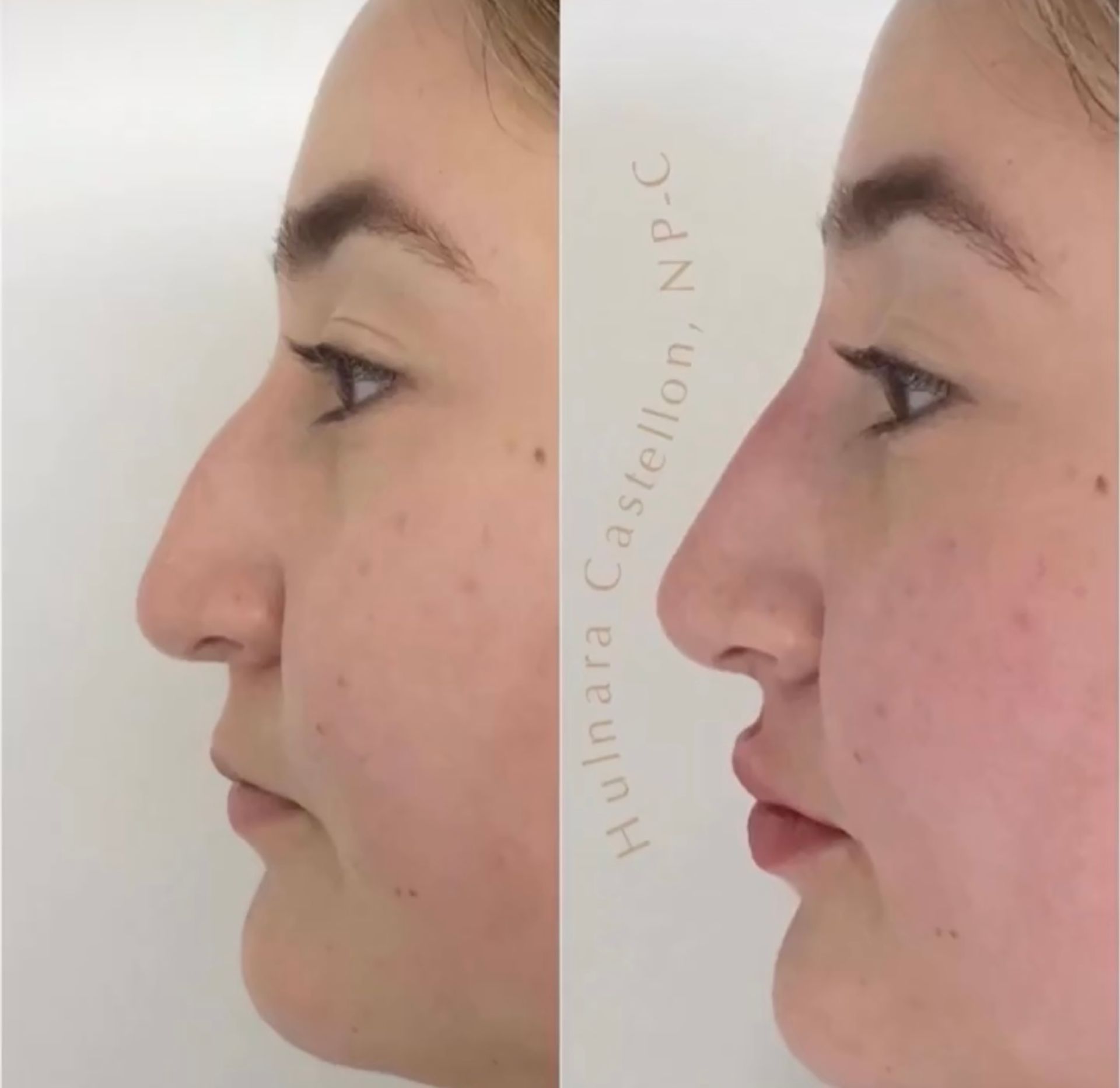 Side-by-side view: Before and after nose reshaping. The after result shows a smoother, more refined nose profile.
