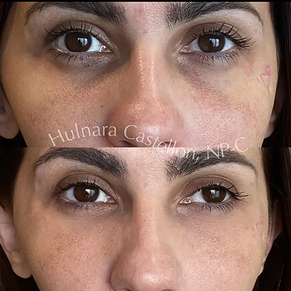 Before-and-after of a person's eyes, showing reduced dark circles and improved skin appearance.
