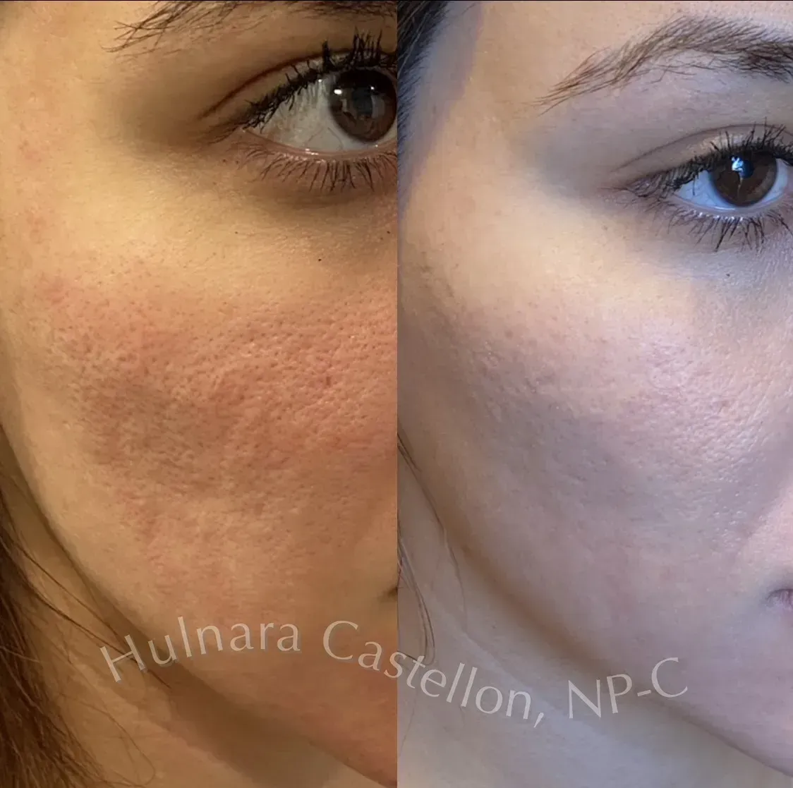 Before and after photos showing skin texture improvement on a person's face after treatment.
