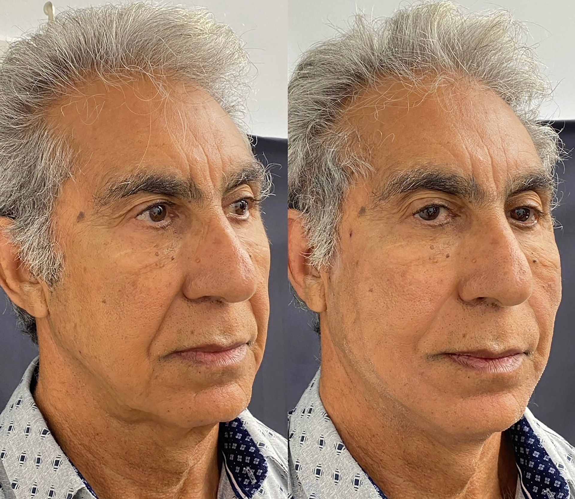 Two side-by-side headshots of a person with gray hair, after his PDO Thread treatment in Redondo Beach, CA>
