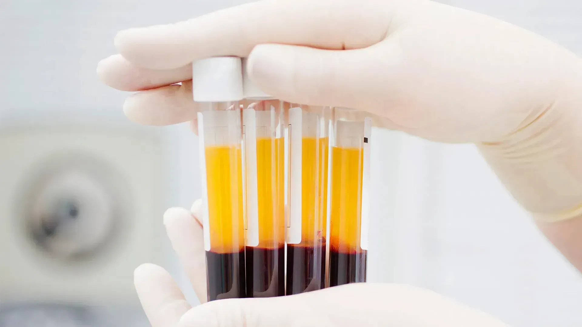 Gloved hands holding tubes of PRP in Redondo Beach, CA, separated into yellow plasma and red blood cells.