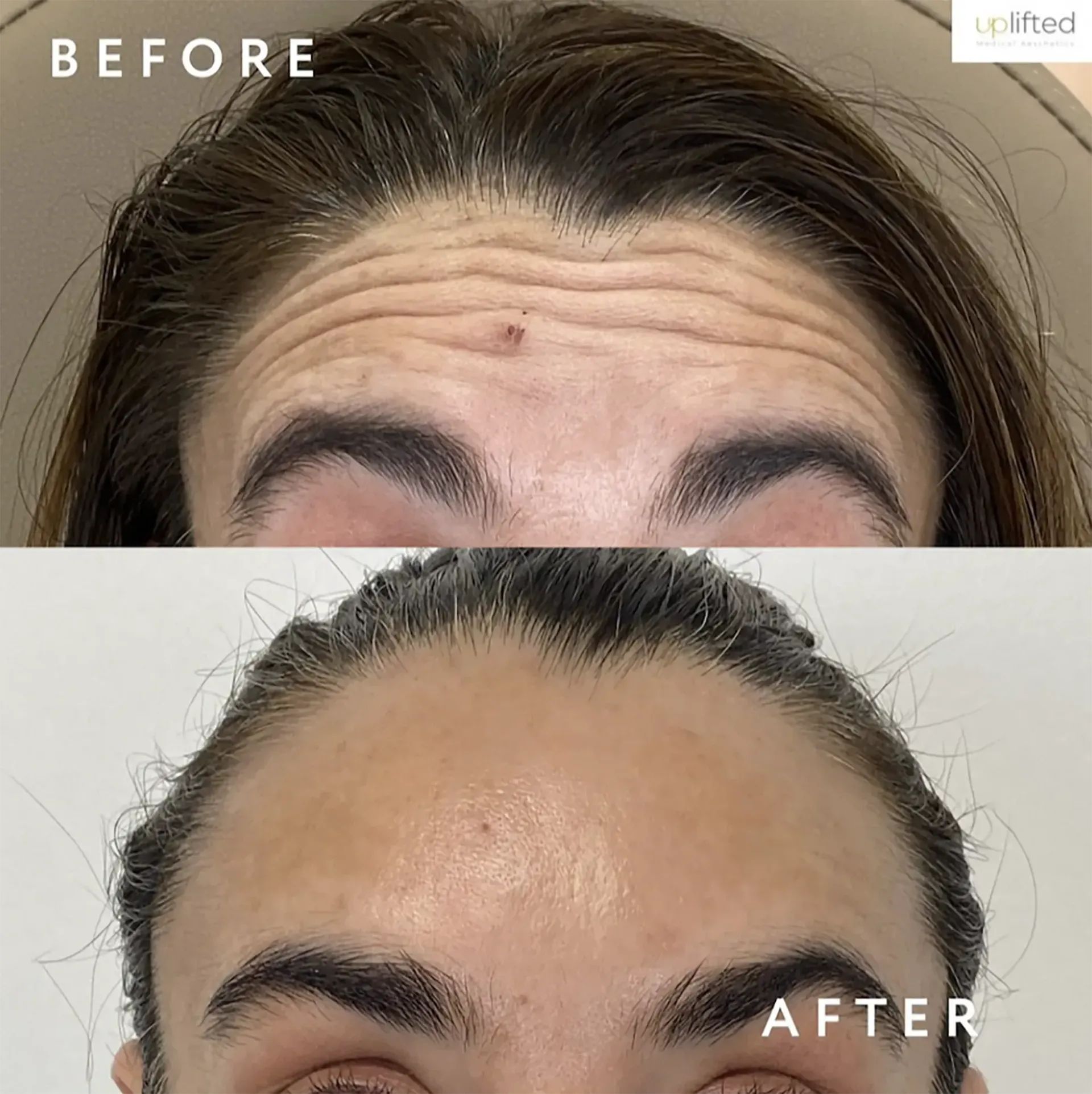 Forehead wrinkles before and after treatment, showing smoother skin after Botox in Redondo Beach, CA, at Uplifted Aesthetics.