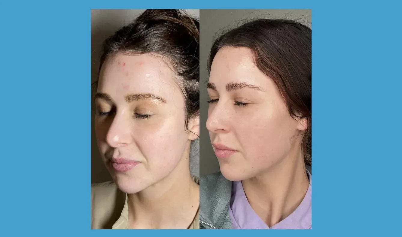 Side-by-side comparison of a person's face. The right side appears smoother, brighter.