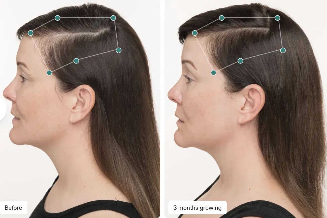 Woman's profile view; hair loss before and after treatment, marked with green dots and lines.
