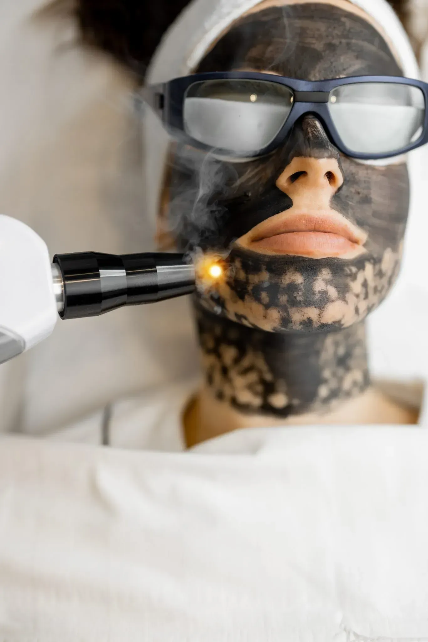 Person with a charcoal face mask undergoing laser skin treatment, wearing protective eyewear.