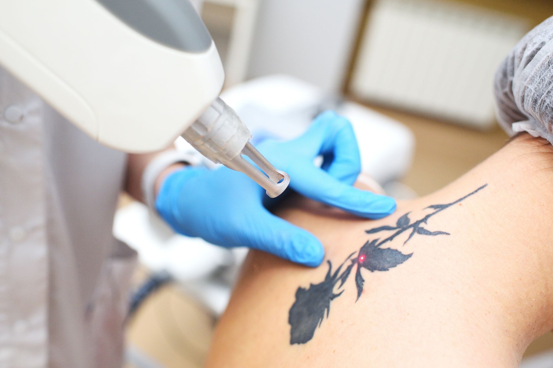 Laser tattoo removal in Redondo Beach, CA-Tattoo of a black floral design; gloved hand holding the skin and laser device.
