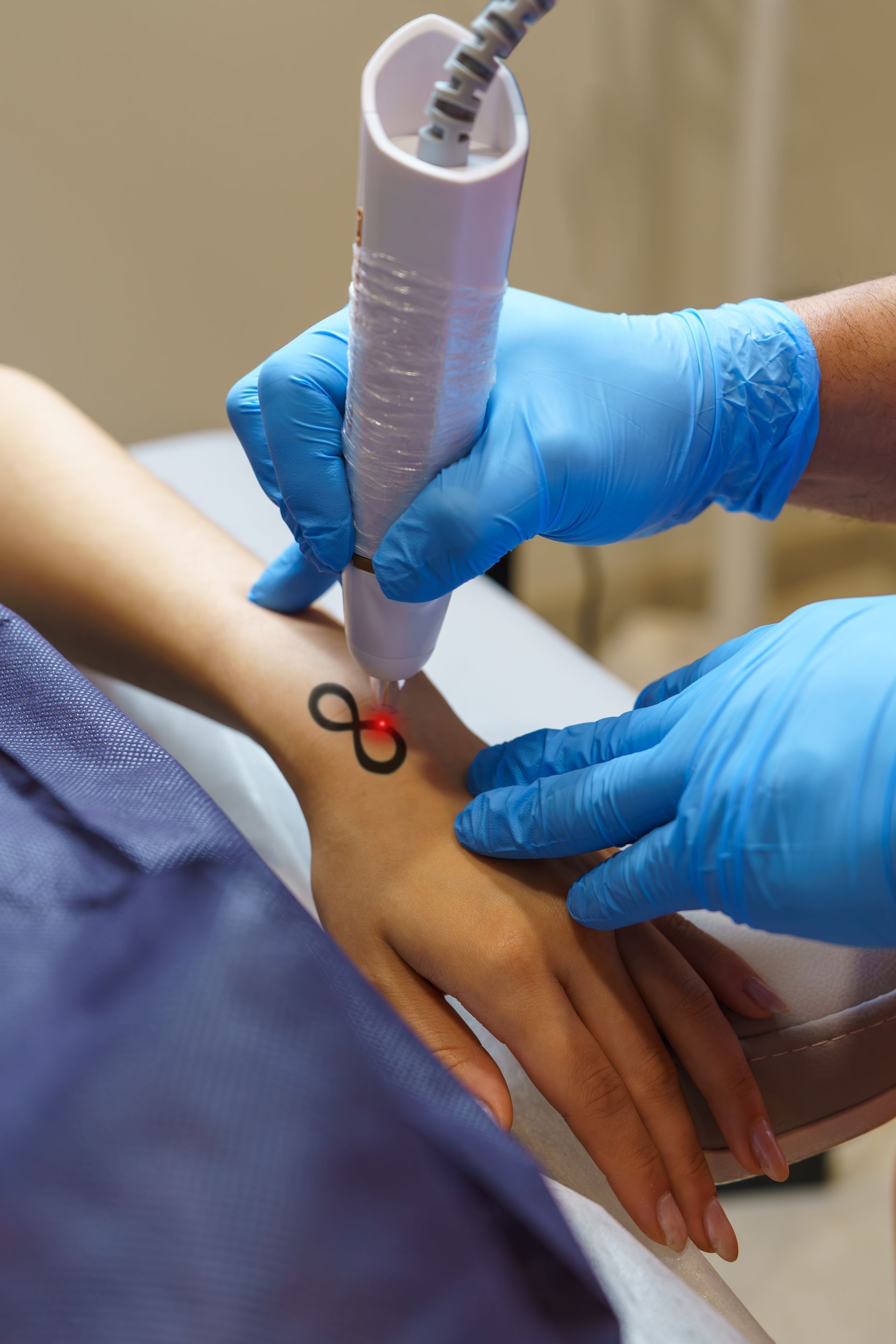 Person's hand with black infinity symbol being treated with a laser. Medical worker wearing blue gloves.