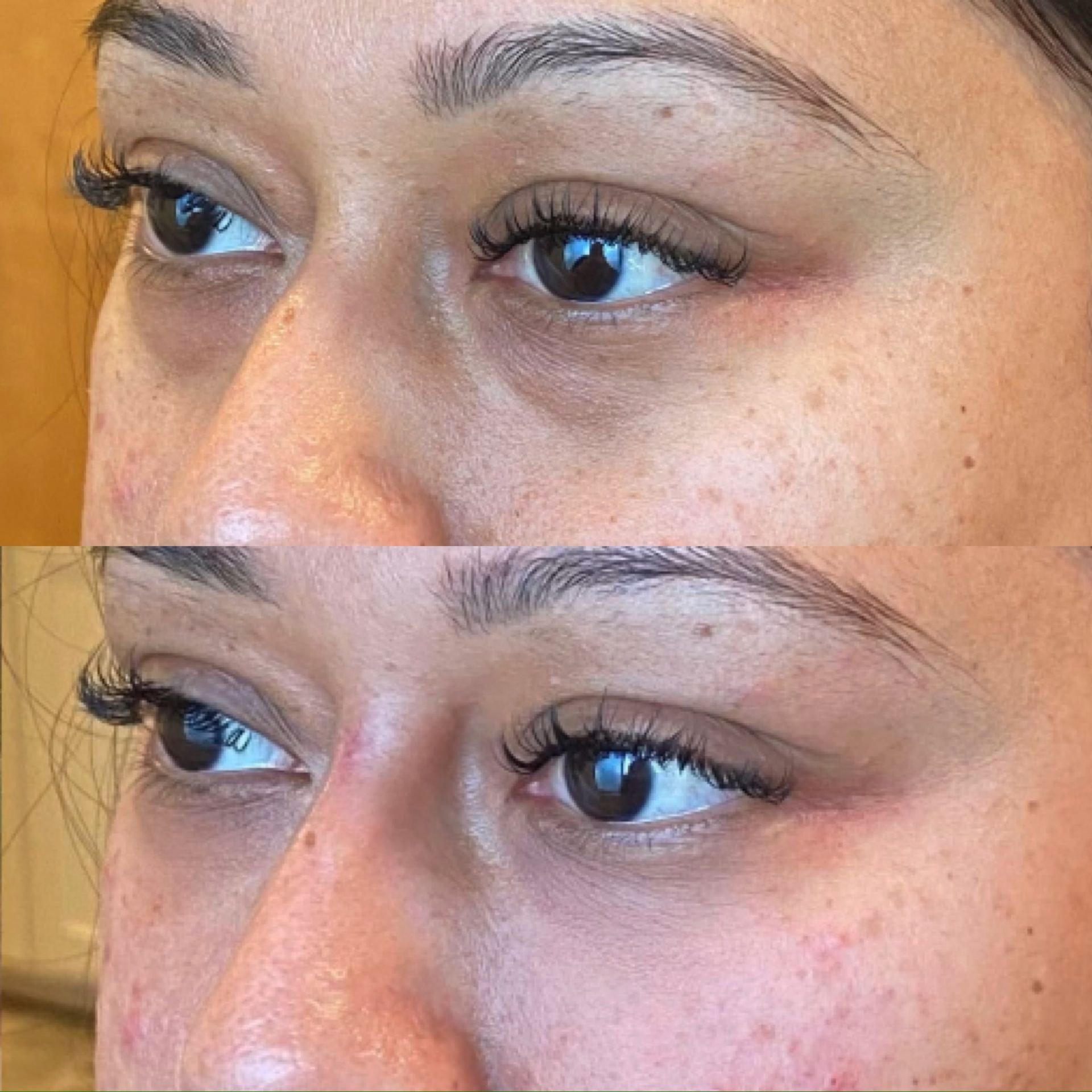 Before and after photos of eyes, showing reduction in under-eye darkness, likely a cosmetic procedure.