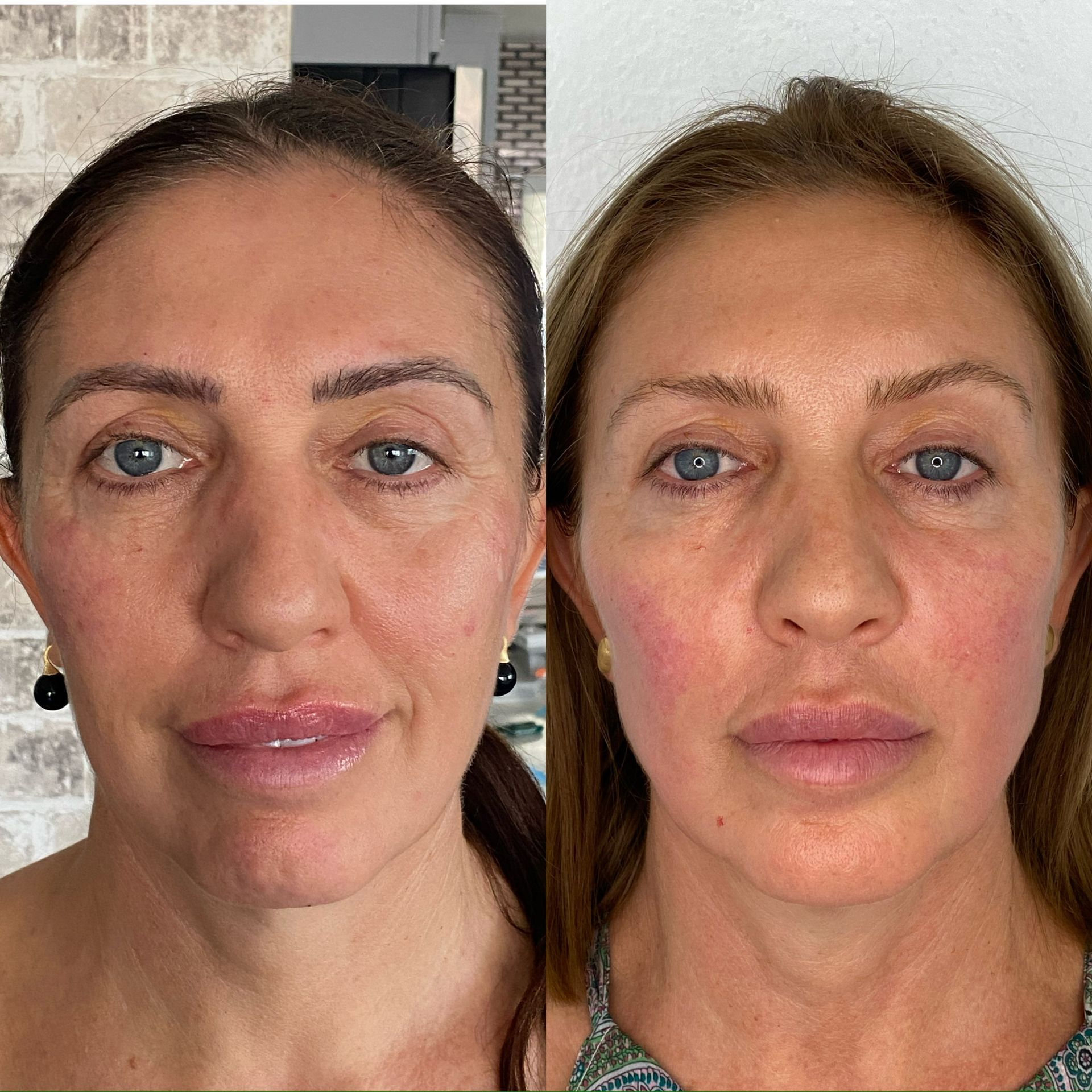 Side-by-side photos of a woman's face, showing before and after treatment with less wrinkles.