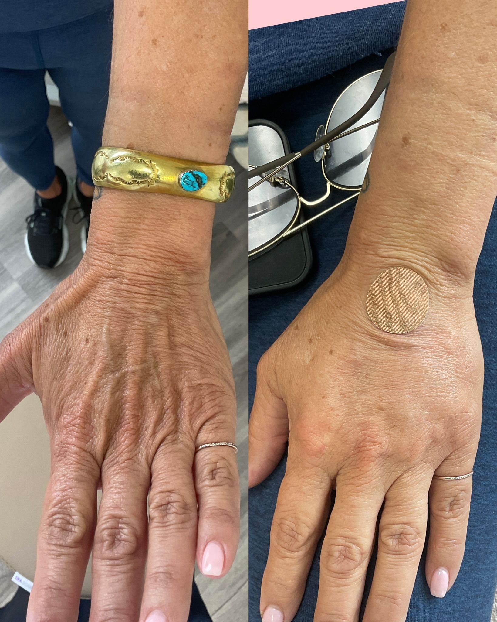 Woman receiving a facial injection; gloved hands holding syringe near cheek, closed eyes, neutral background.