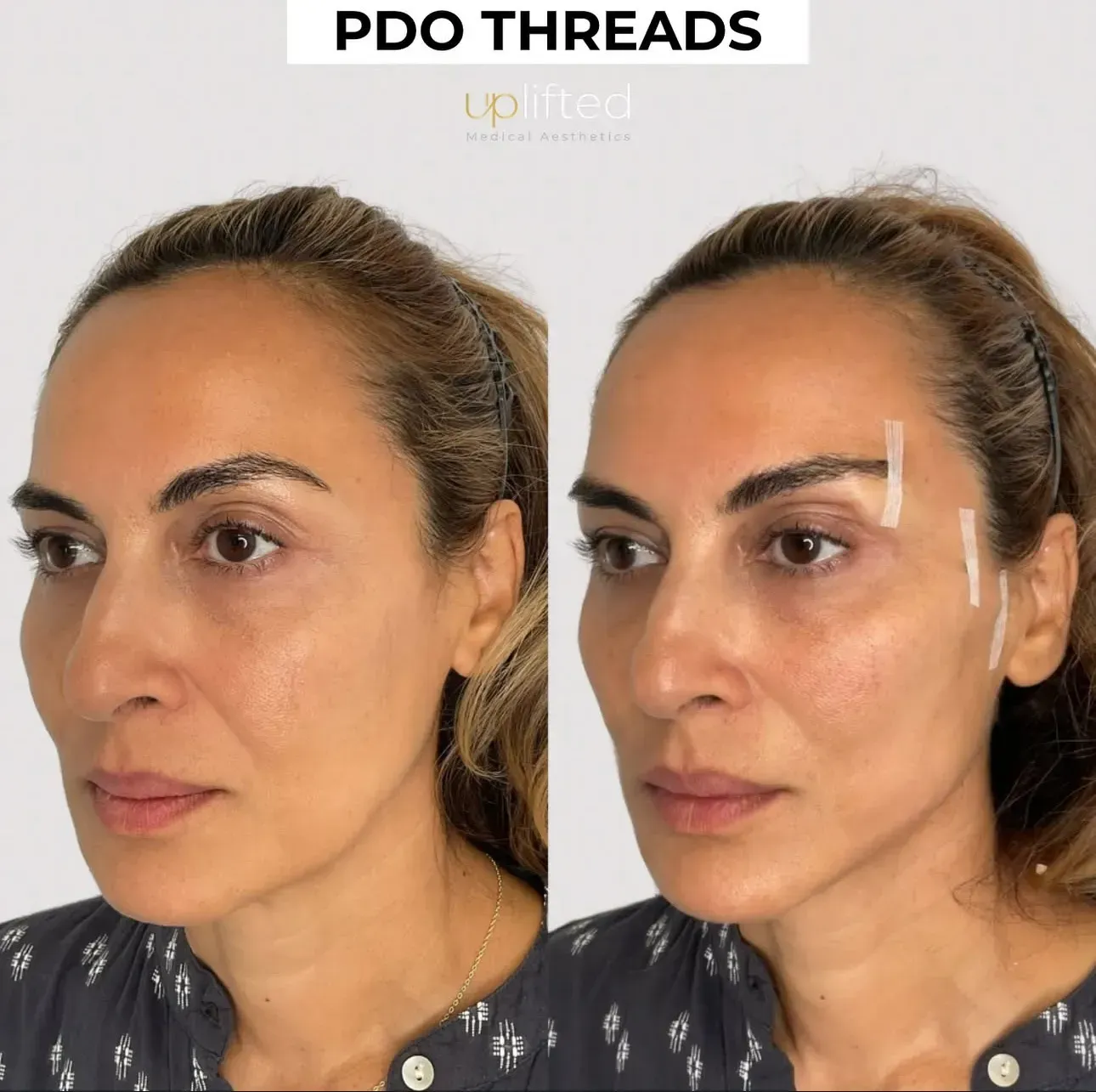 Comparison of woman's face before and after PDO thread lift treatment, with marking tapes on her face.