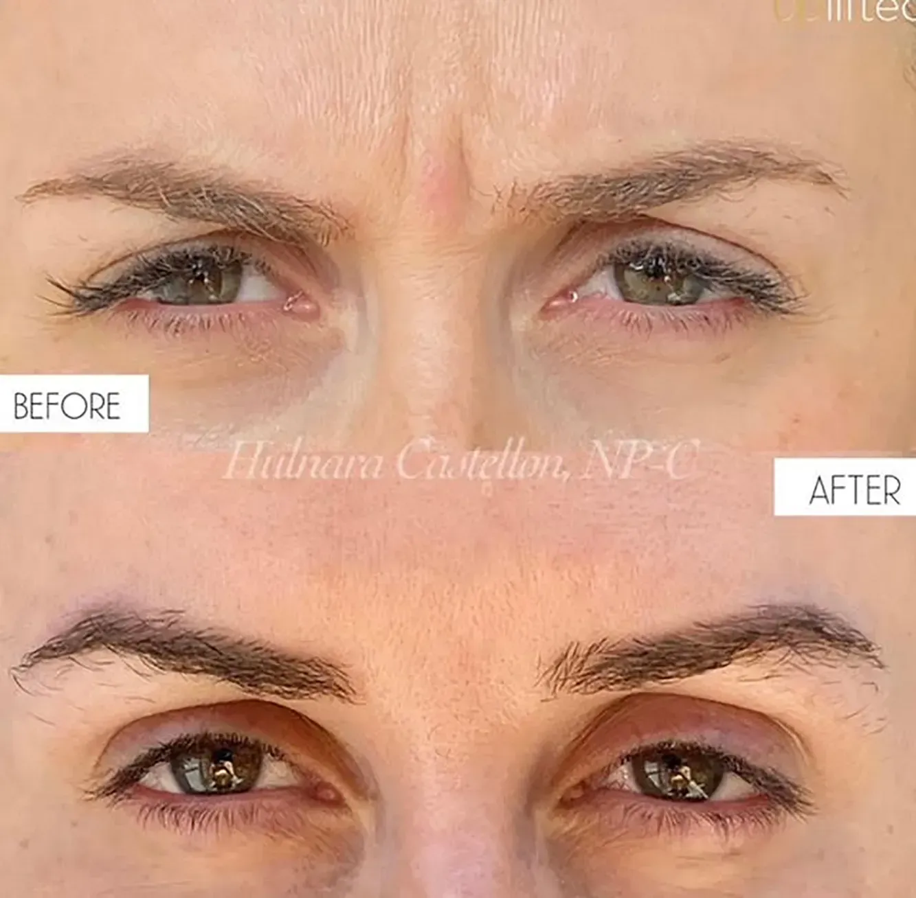 Before and after comparison of brow wrinkle reduction: top, furrowed brow; bottom, smoothed brow.