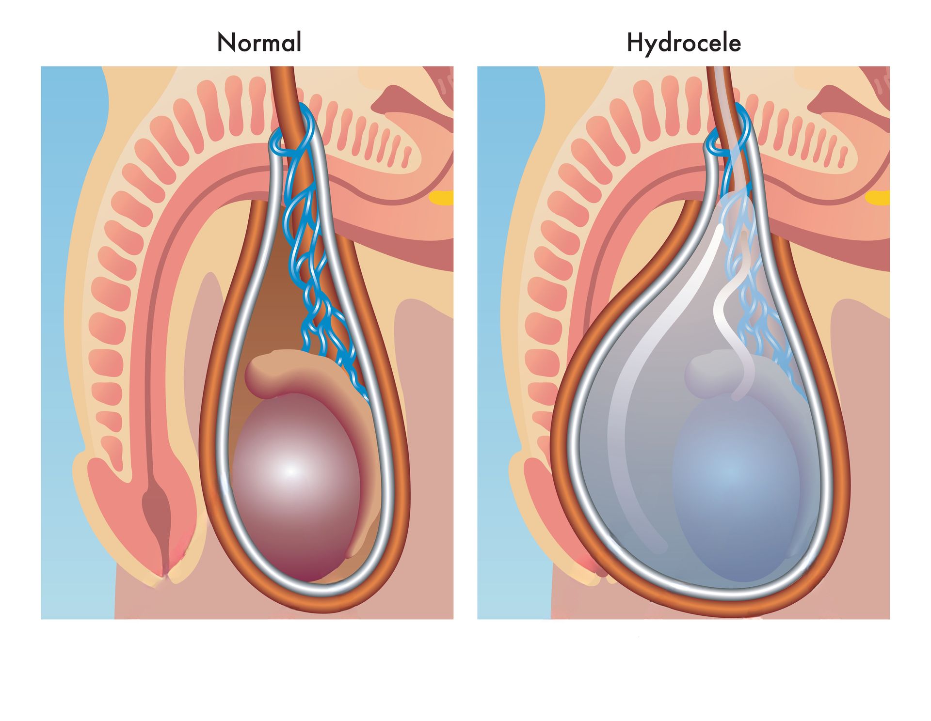 O que é e como tratar a hidrocele testicular