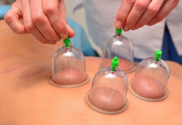 A person is getting cupping treatment on their back.
