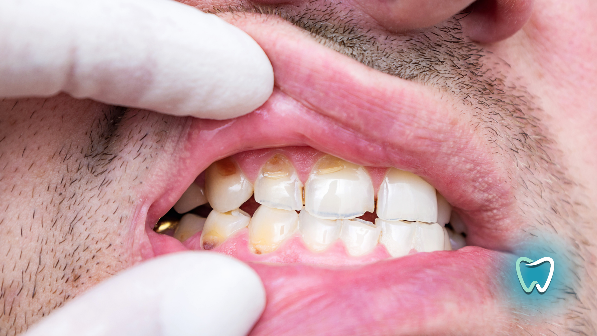 A man is getting his teeth examined by a dentist.