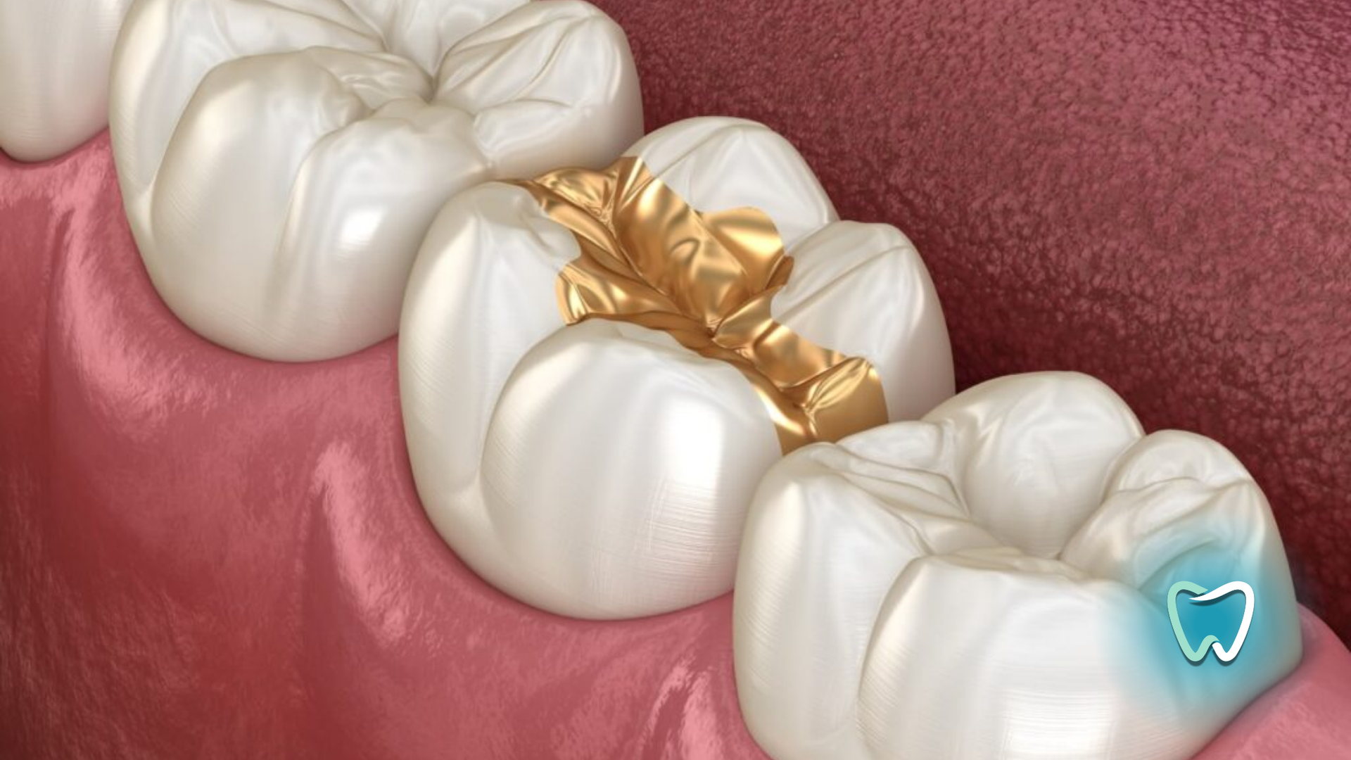 A close up of a row of teeth with gold fillings.