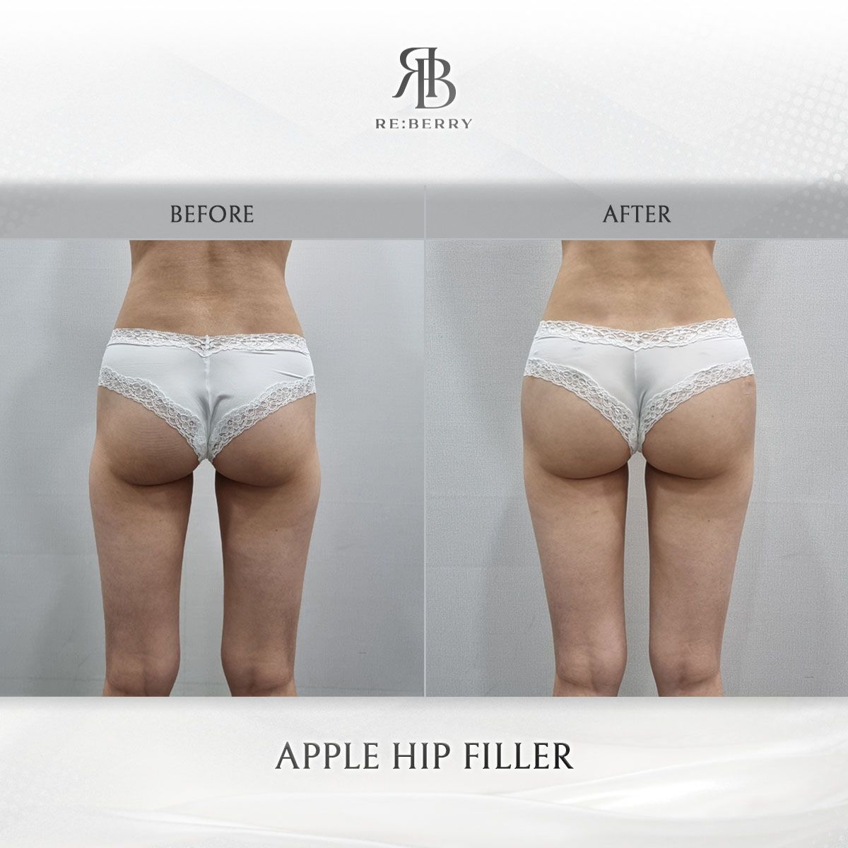Body Fillers before and after at RE:BERRY Clinic Myeongdong