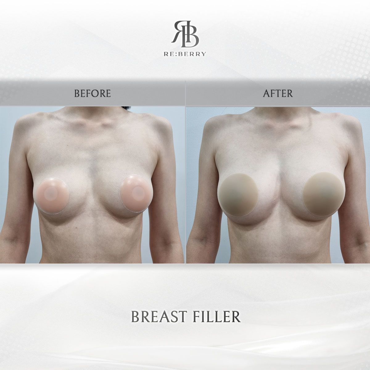 Body Fillers before and after photo 2, RE:BERRY Clinic Myeongdong