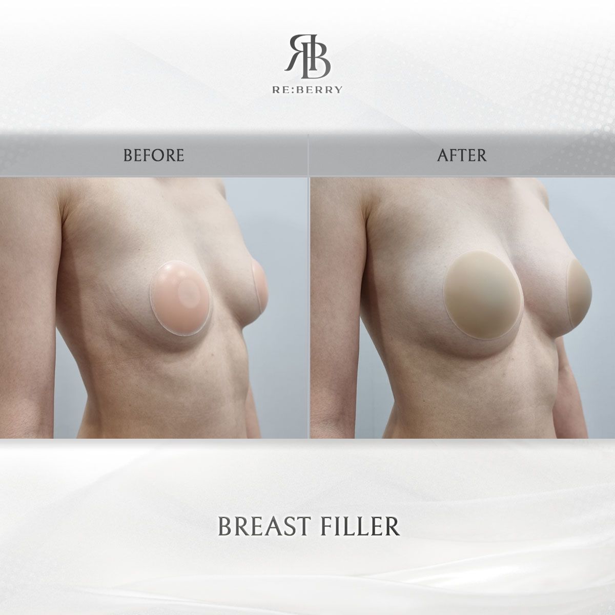 Body Fillers before and after photo 3, RE:BERRY Clinic Myeongdong