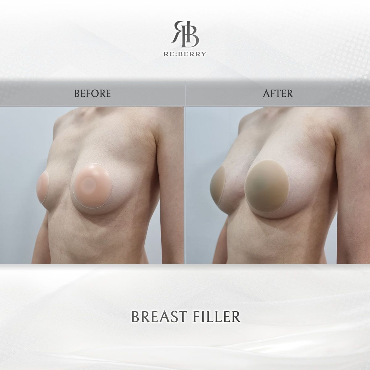 Body Fillers before and after photo 4, RE:BERRY Clinic Myeongdong