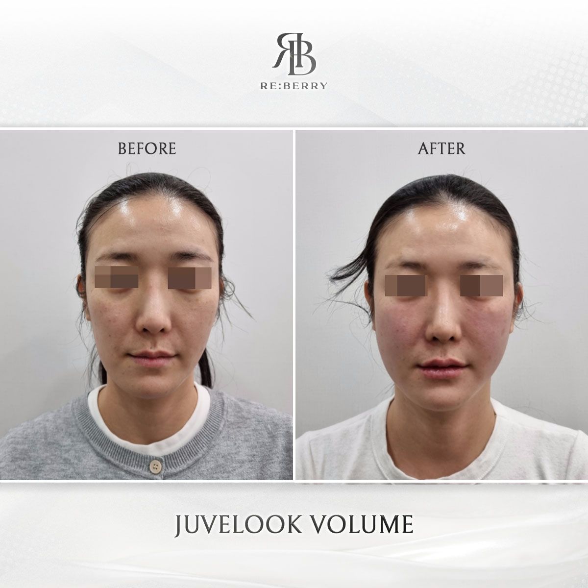 Juvelook Volume before and after at RE:BERRY Clinic Myeongdong