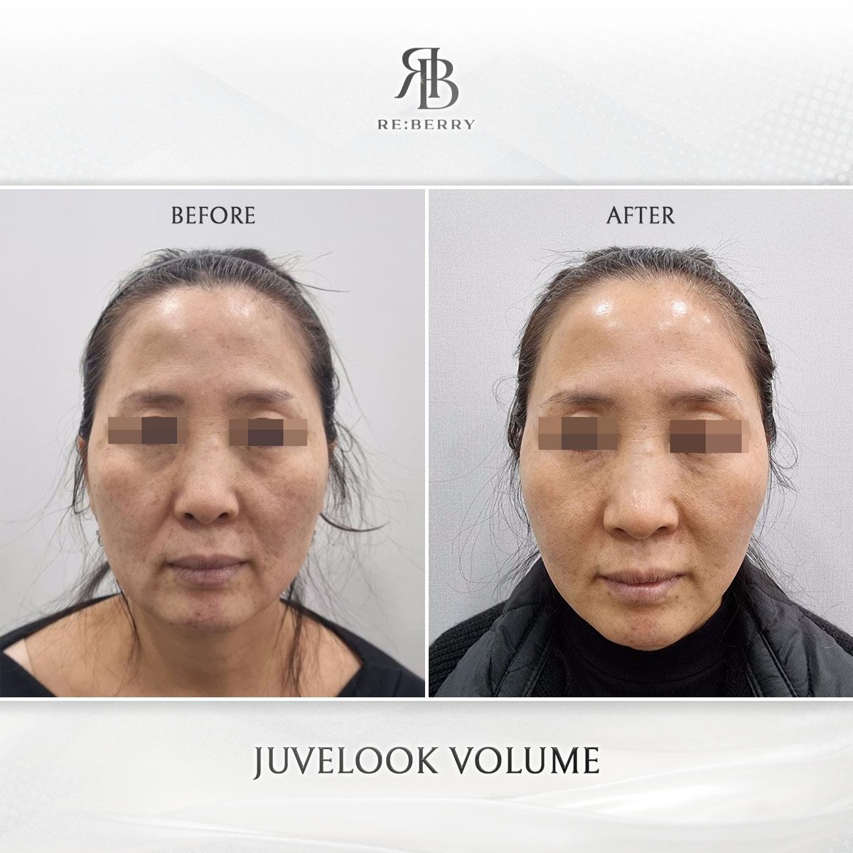 Juvelook Volume before and after photo 15, RE:BERRY Clinic Myeongdong