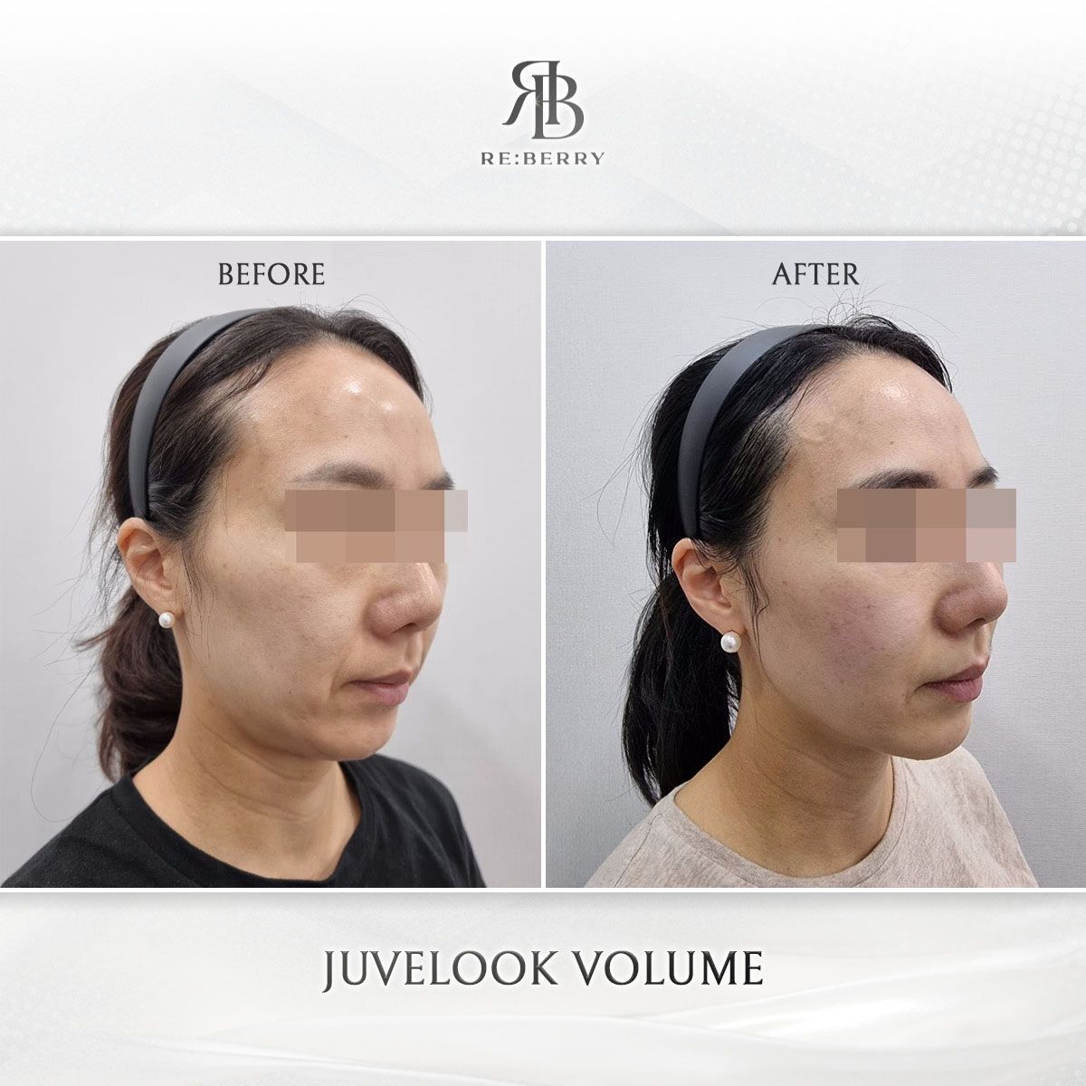 Juvelook Volume before and after photo 16, RE:BERRY Clinic Myeongdong