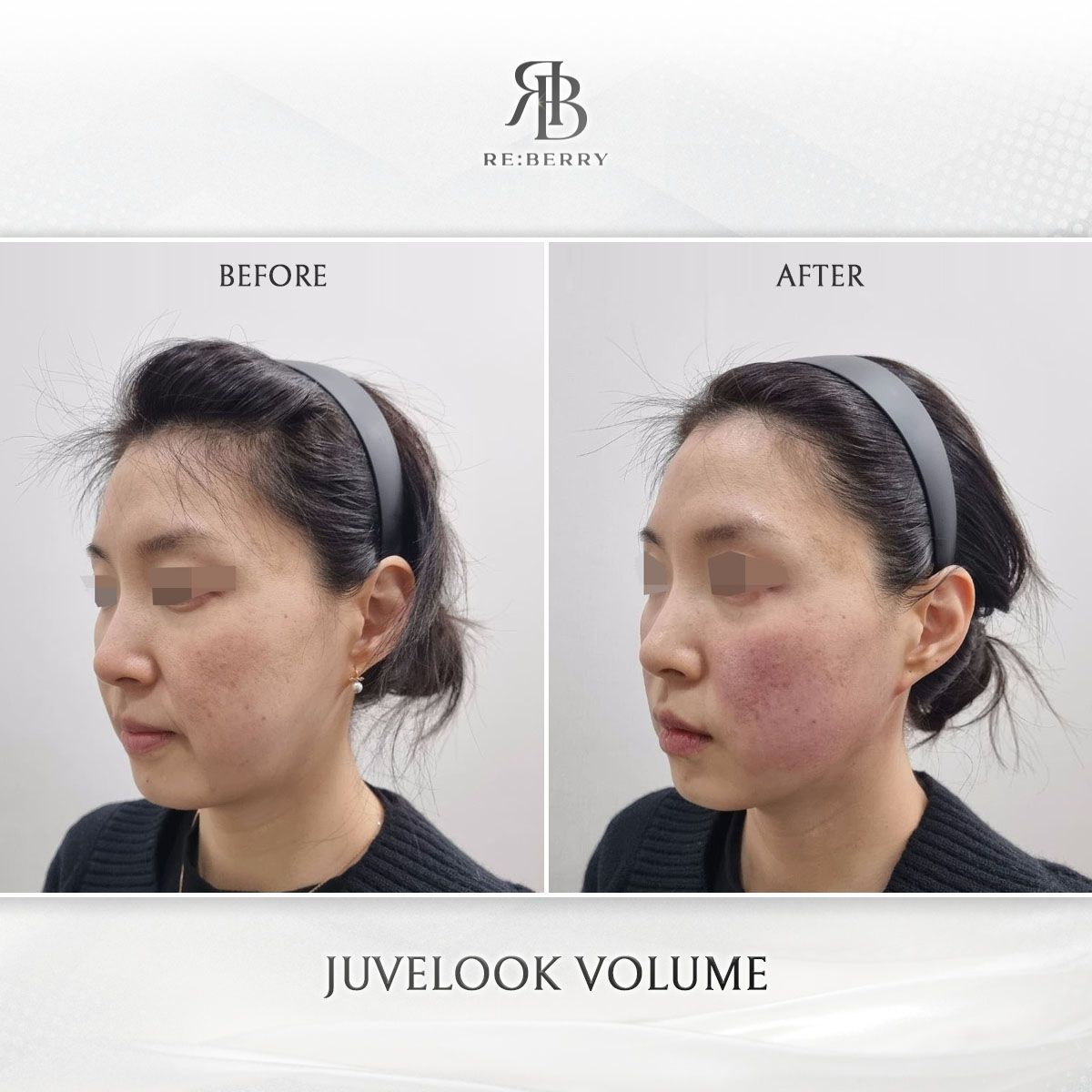 Juvelook Volume before and after photo 17, RE:BERRY Clinic Myeongdong