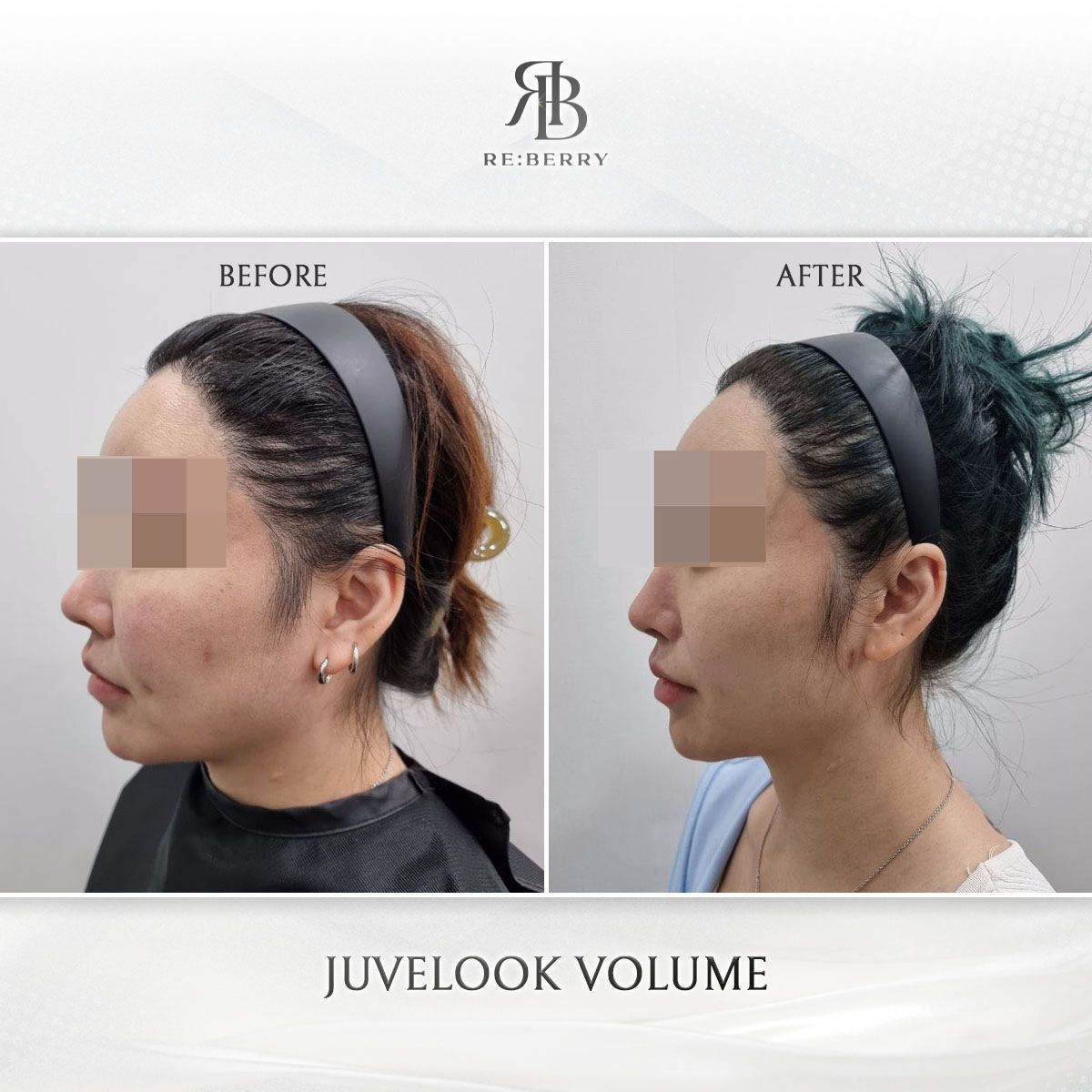 Juvelook Volume before and after photo 4, RE:BERRY Clinic Myeongdong