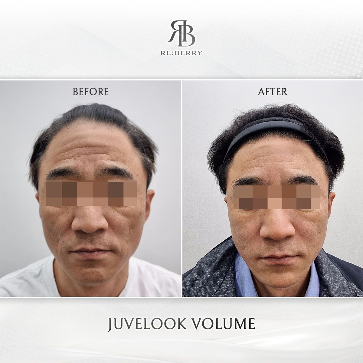 Juvelook Volume before and after photo 5, RE:BERRY Clinic Myeongdong