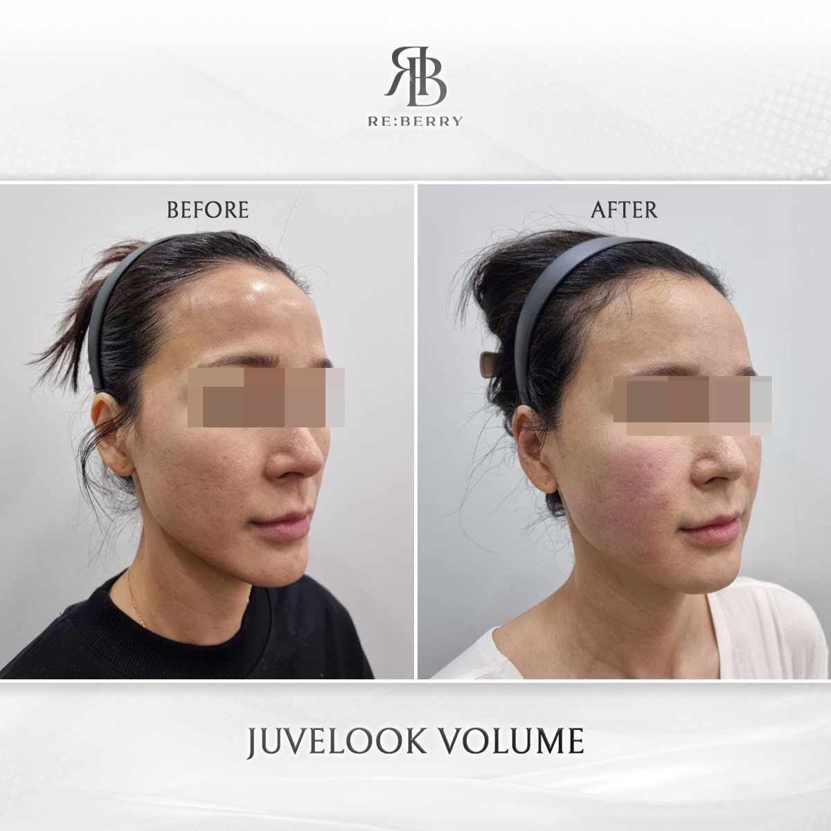 Juvelook Volume before and after photo 6, RE:BERRY Clinic Myeongdong