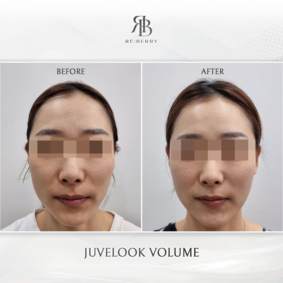 Juvelook Volume before and after photo 8, RE:BERRY Clinic Myeongdong