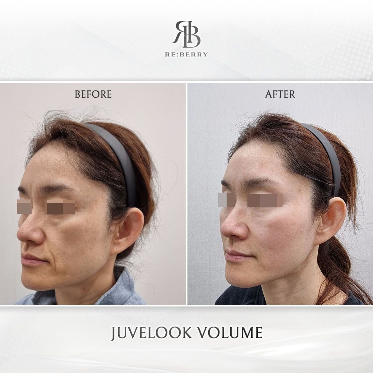 Juvelook Volume before and after photo 9, RE:BERRY Clinic Myeongdong