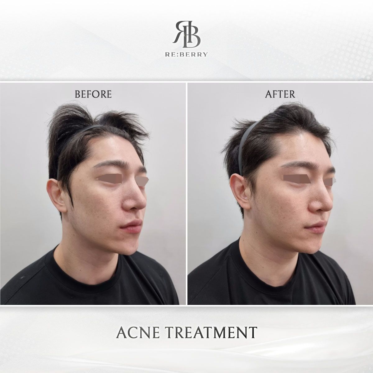 Acne & Acne Scar Treatment before and after photo 1, RE:BERRY Clinic Myeongdong