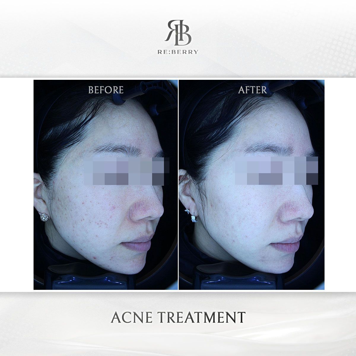 Acne & Acne Scar Treatment before and after photo 3, RE:BERRY Clinic Myeongdong