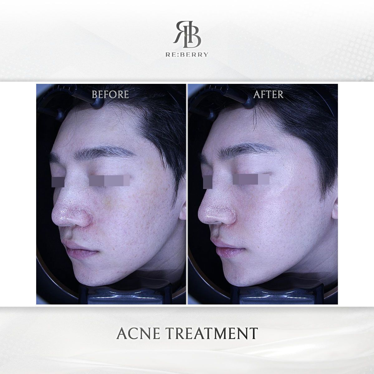 Acne & Acne Scar Treatment before and after photo 4, RE:BERRY Clinic Myeongdong