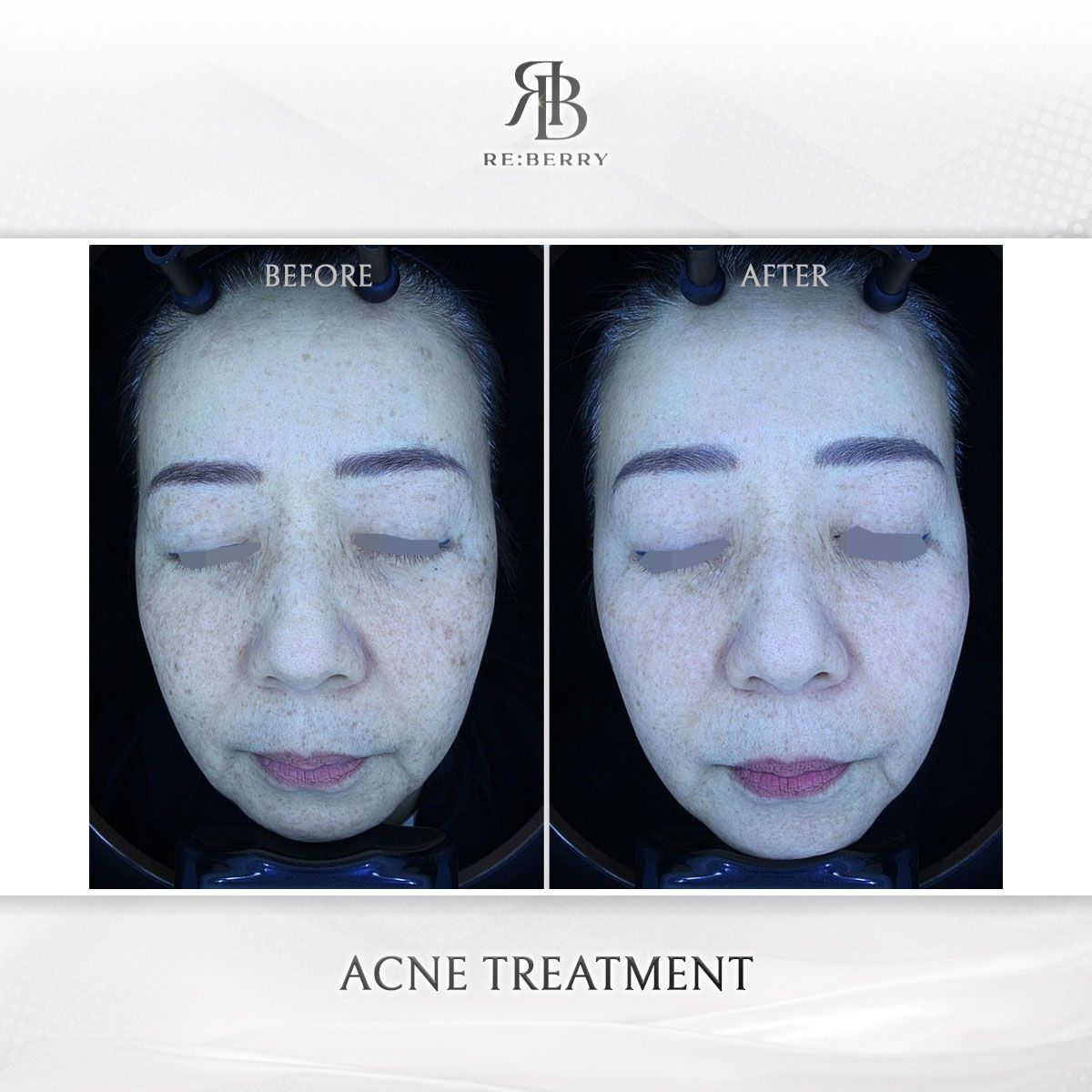 Acne & Acne Scar Treatment before and after photo 5, RE:BERRY Clinic Myeongdong