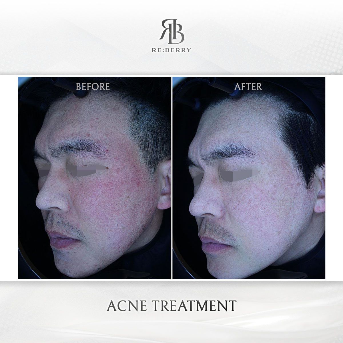Acne & Acne Scar Treatment before and after photo 6, RE:BERRY Clinic Myeongdong