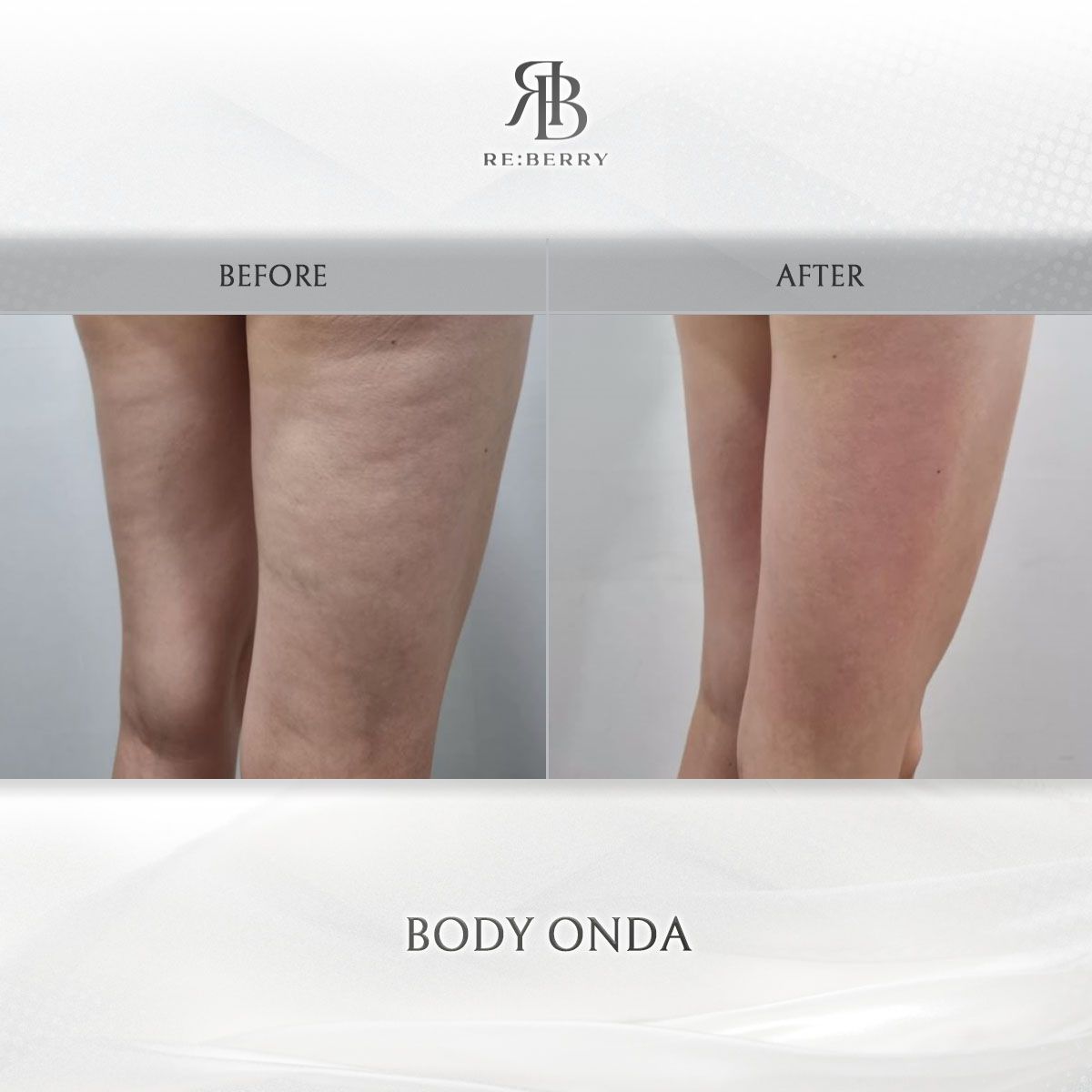 Body Onda before and after at RE:BERRY Clinic Myeongdong