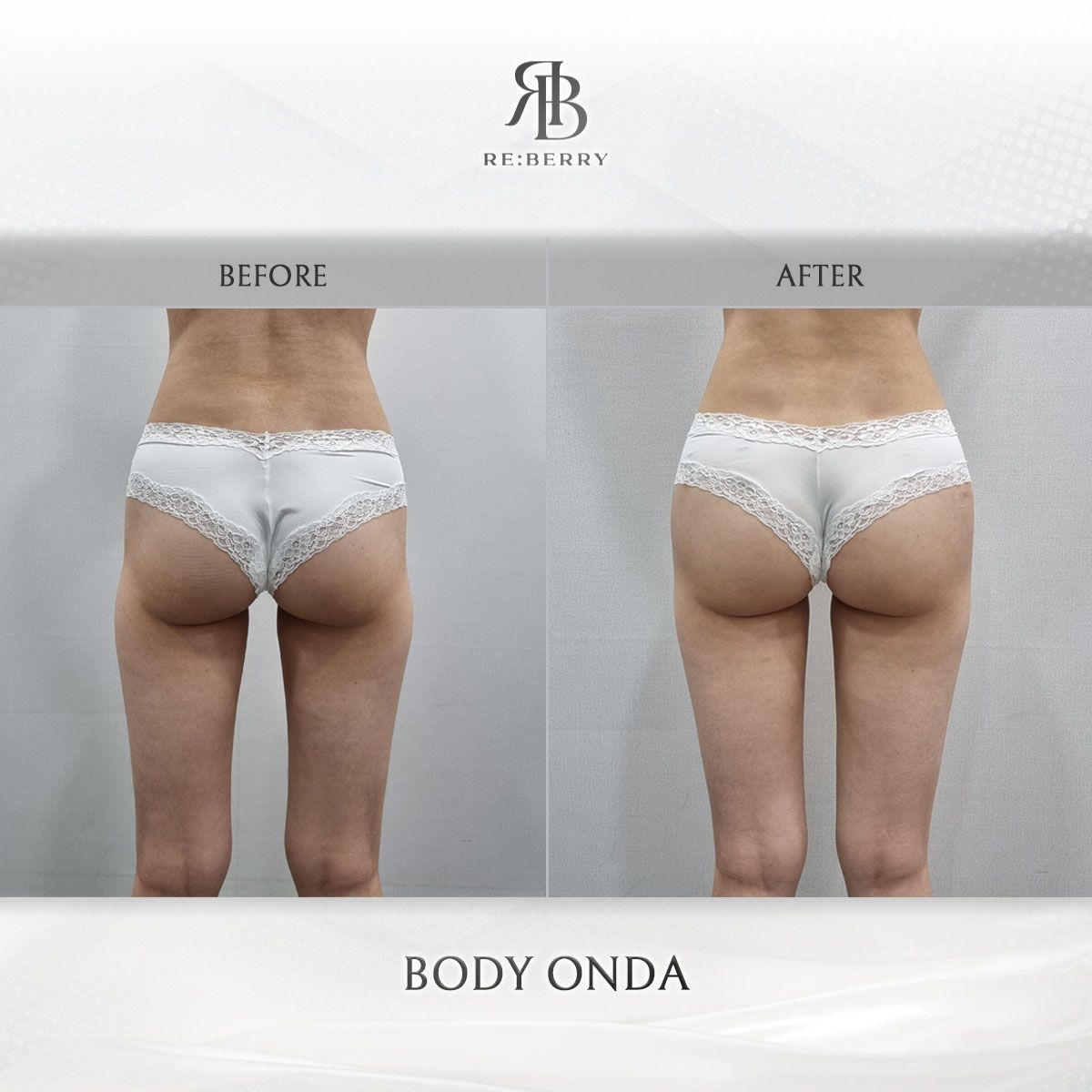 Body Onda before and after photo 2, RE:BERRY Clinic Myeongdong