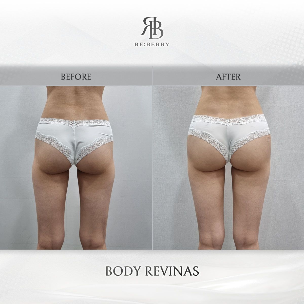 Body Revinas before and after photo 2, RE:BERRY Clinic Myeongdong