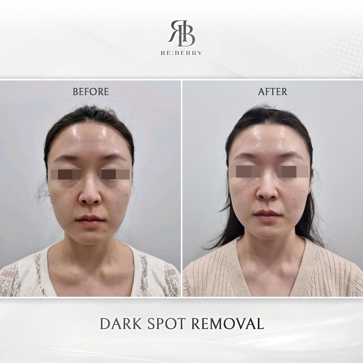 Dark Spot Removal before and after at RE:BERRY Clinic Myeongdong