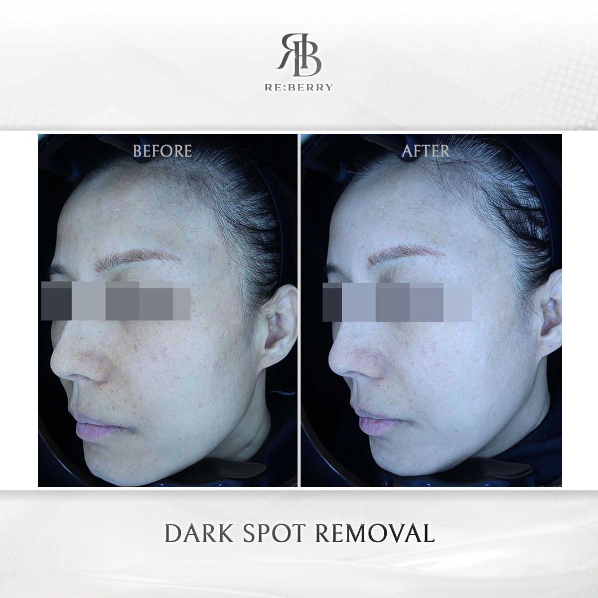 Dark Spot Removal before and after photo 2, RE:BERRY Clinic Myeongdong