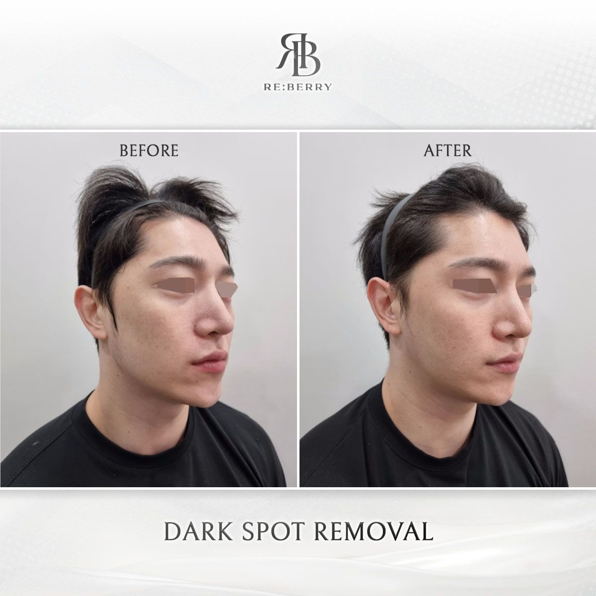Dark Spot Removal before and after photo 3, RE:BERRY Clinic Myeongdong