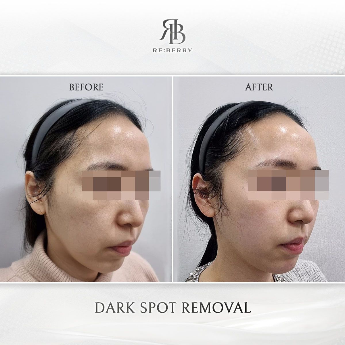 Dark Spot Removal before and after photo 5, RE:BERRY Clinic Myeongdong