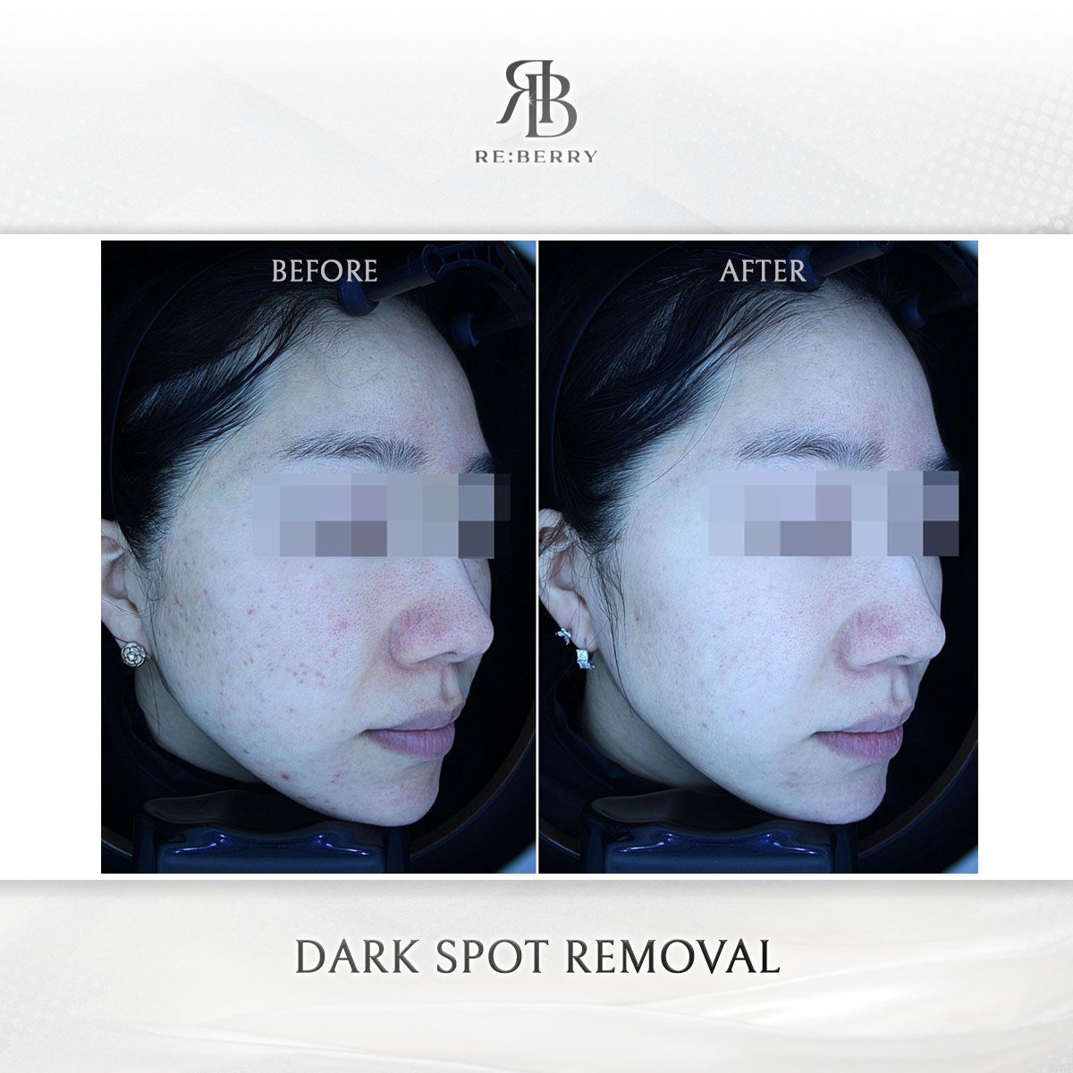 Dark Spot Removal before and after photo 6, RE:BERRY Clinic Myeongdong