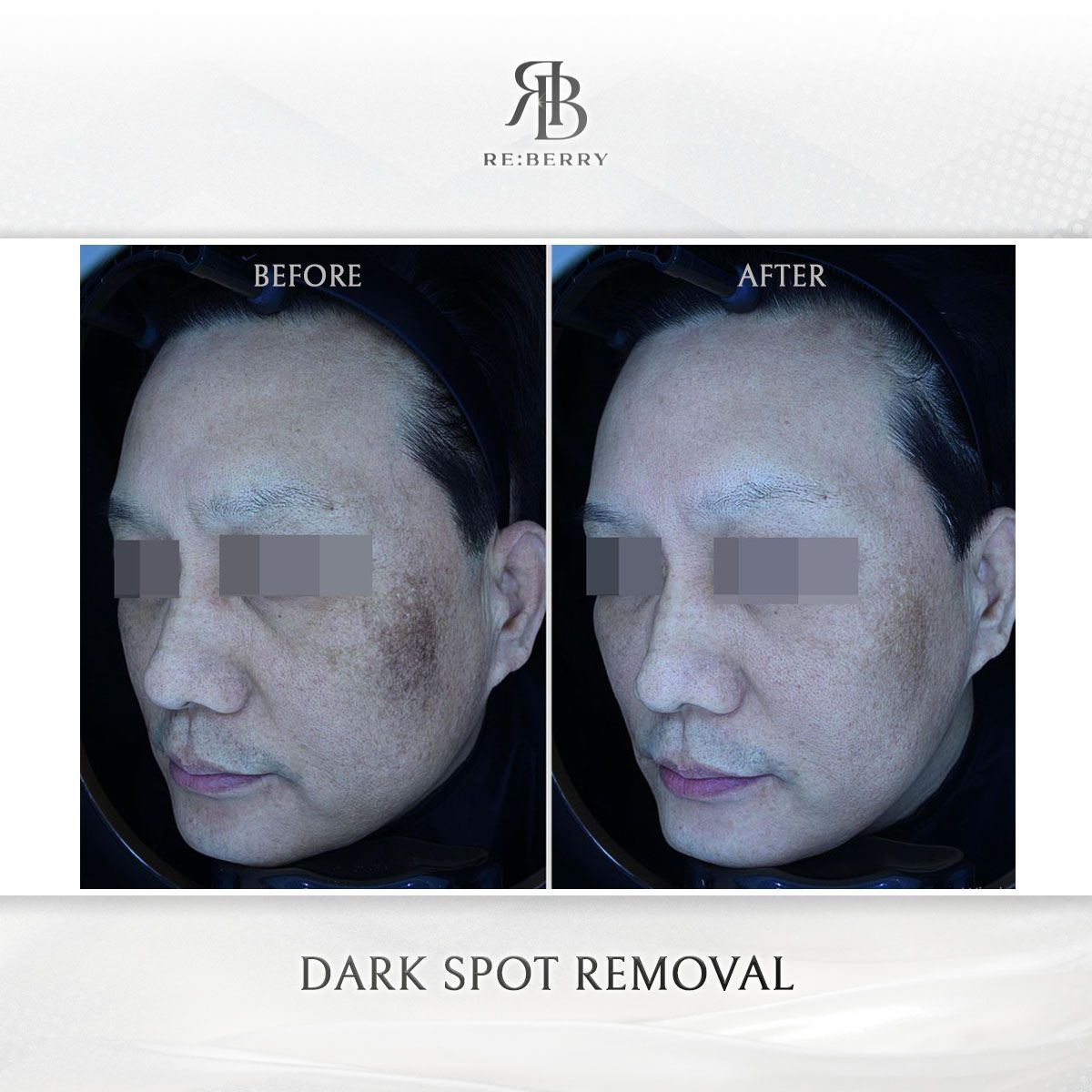 Dark Spot Removal before and after photo 7, RE:BERRY Clinic Myeongdong
