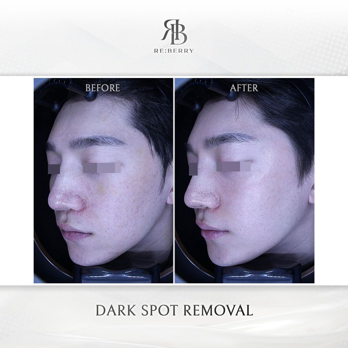 Dark Spot Removal before and after photo 8, RE:BERRY Clinic Myeongdong