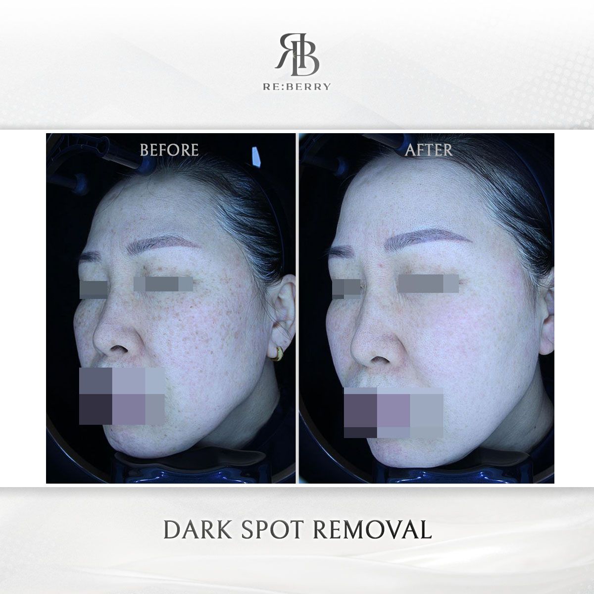Dark Spot Removal before and after photo 9, RE:BERRY Clinic Myeongdong